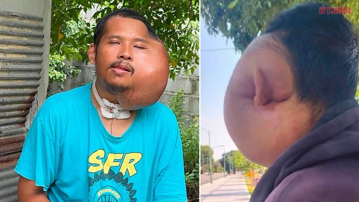หนุ่มป่วยสุดทรมาน หน้าบวมครึ่งซีก สาเหตุเกิดจาก “ฟันผุกับไม้จิ้มฟัน” โพสต์รูปก็ถูกด่าว่าใช้ AI