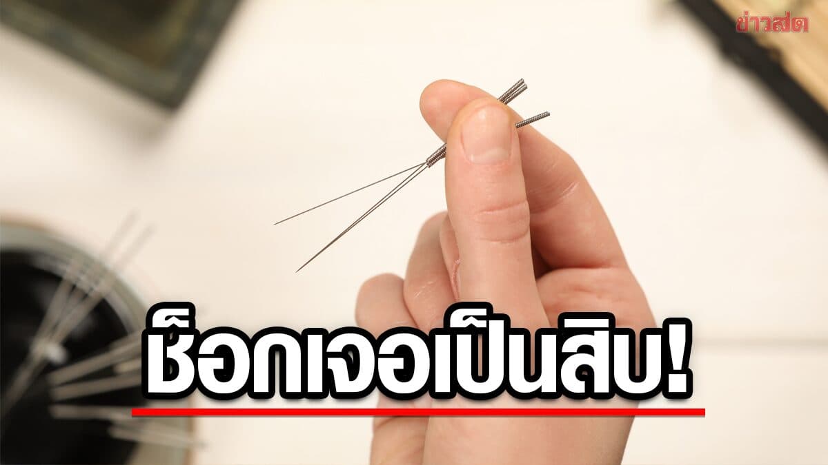 หญิงรัสเซียปวดขารุนแรง หลัง “ฝังเข็ม” เพียงครั้งเดียว ผลเอกซเรย์สุดช็อก!