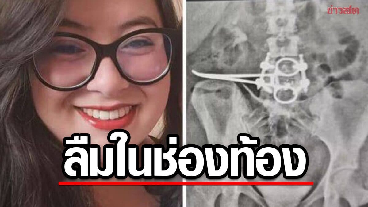หญิงบราซิล ผ่าตัดมดลูก สุดช็อกแพทย์ลืมกรรไกรผ่าตัดยาว 18 ซม. ในช่องท้อง 3 เดือน