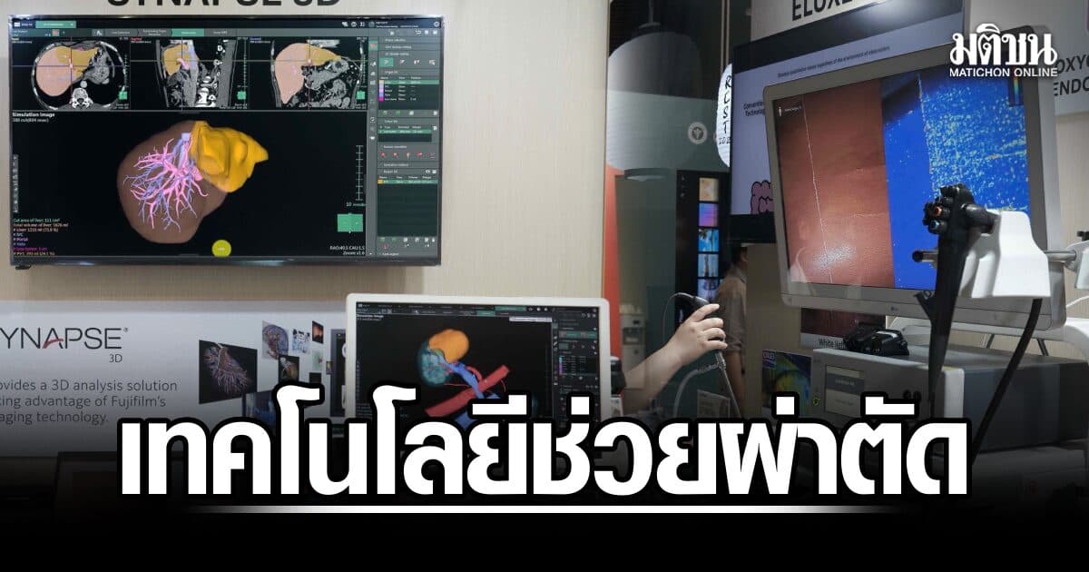 ชู OXEI แสดงระดับออกซิเจนในเนื้อเยื่อแบบเรียลไทม์ หนุนศัลยแพทย์ตัดสินใจแม่นยำ-ปลอดภัย